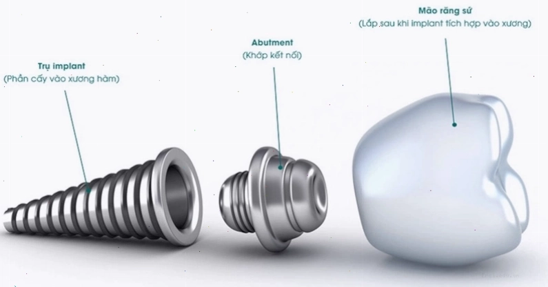 So sánh các loại trụ implant 2