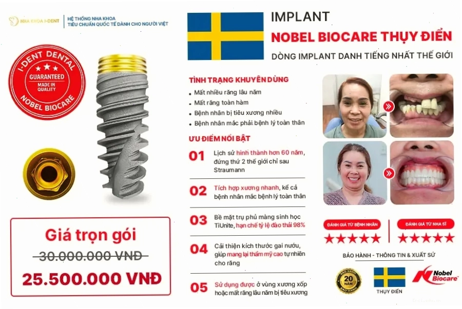So sánh các loại trụ implant theo thời gian tồn tại và hiệu quả