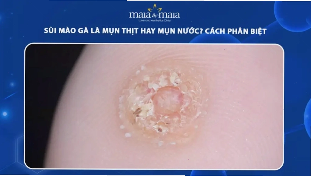 So sánh hình ảnh sùi mào gà và mụn thịt