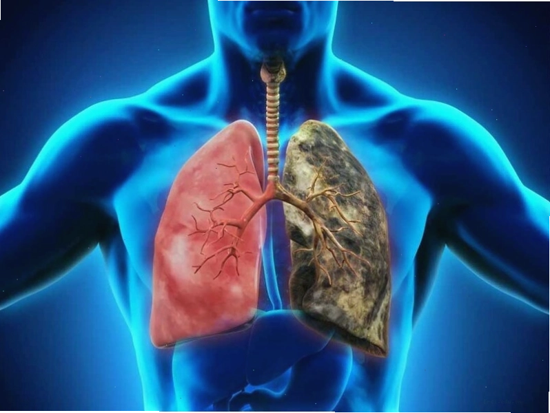 So sánh mức độ nghiêm trọng giữa viêm phổi và viêm phế quản