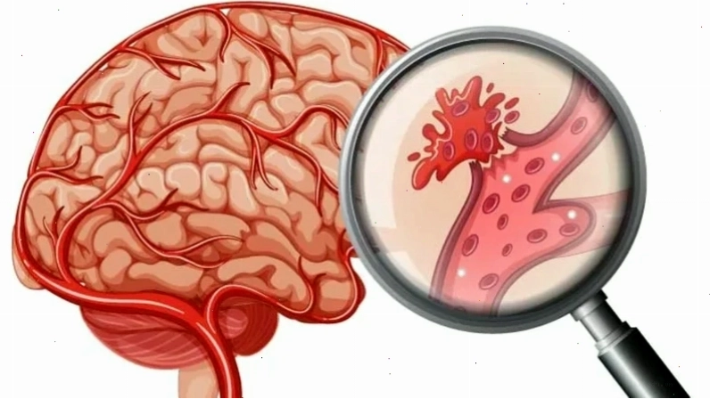 So sánh mức độ nguy hiểm: Nhồi máu não và Xuất huyết não