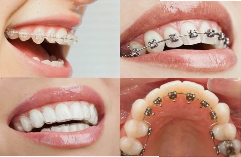 So sánh trực quan giữa hô hàm và hô răng