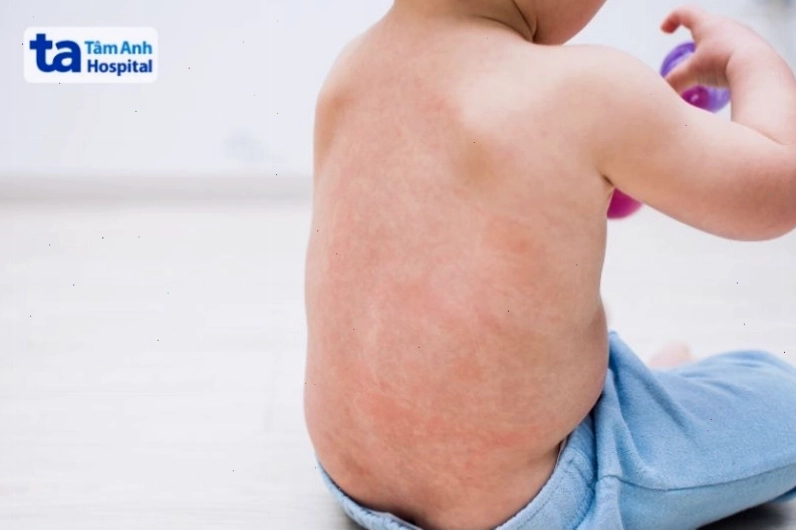 Sốt phát ban và sốt xuất huyết có triệu chứng gần như nhau nhưng khác nhau ở ban và biến chứng