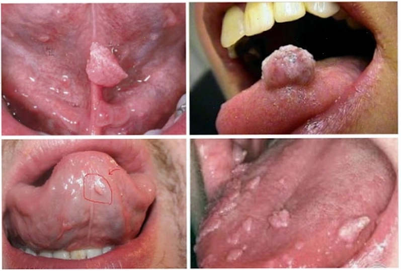 Sự khác biệt giữa sùi mào gà và nhiệt miệng