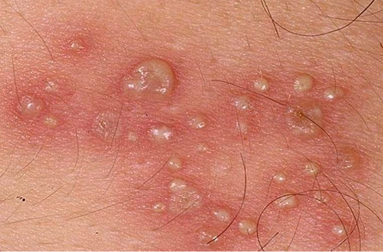 Sùi mào gà ở nam giới với các nốt sần nhỏ