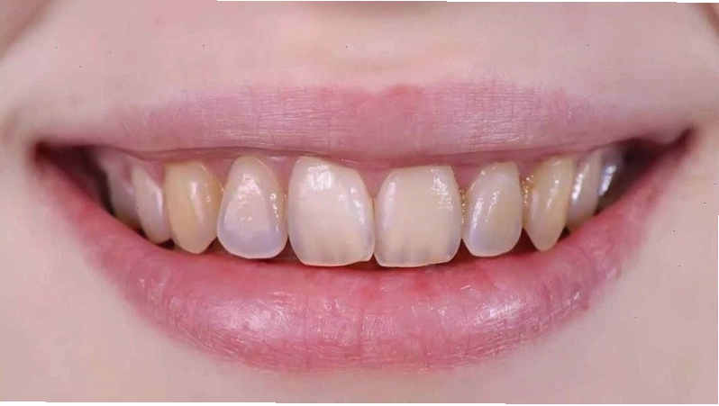 Tác dụng phụ có thể gặp khi dùng giấm táo mèo