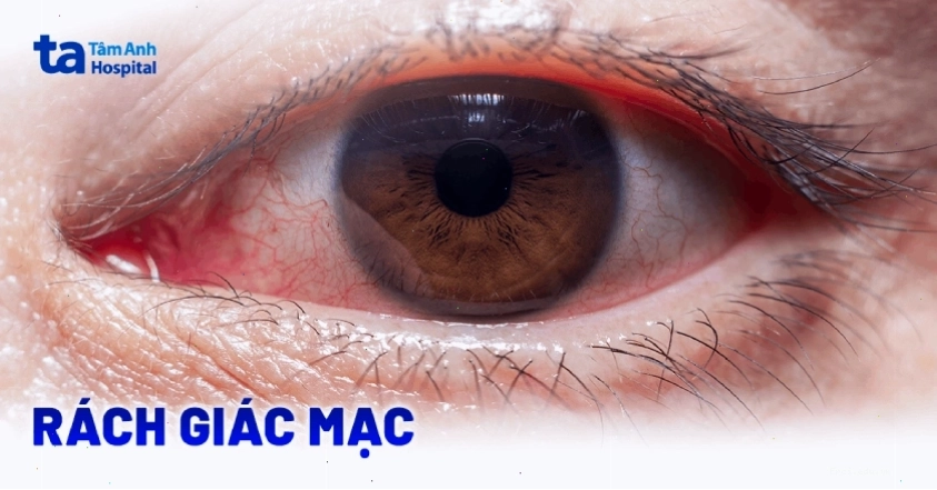 Tầm quan trọng của việc điều trị ghẻ xốn đúng cách