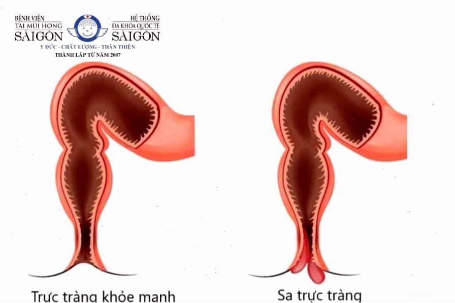 Táo bón kéo dài có thể dẫn đến biến chứng sa trực tràng