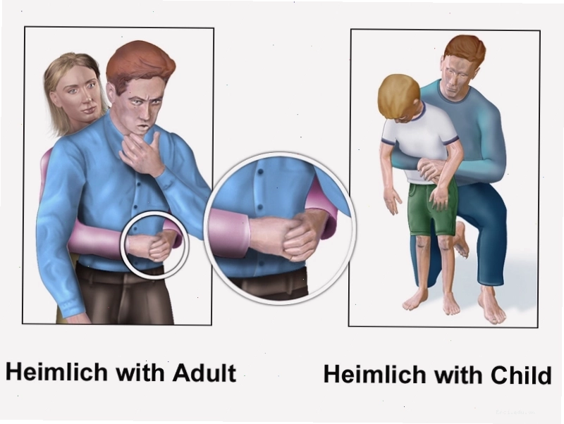 Thao tác ép bụng, vỗ lưng có thể hỗ trợ đẩy xương cá