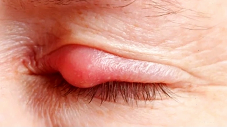Thực hiện mẹo chữa lẹo mắt bằng chỉ cần sự cẩn thận và nhẹ nhàng