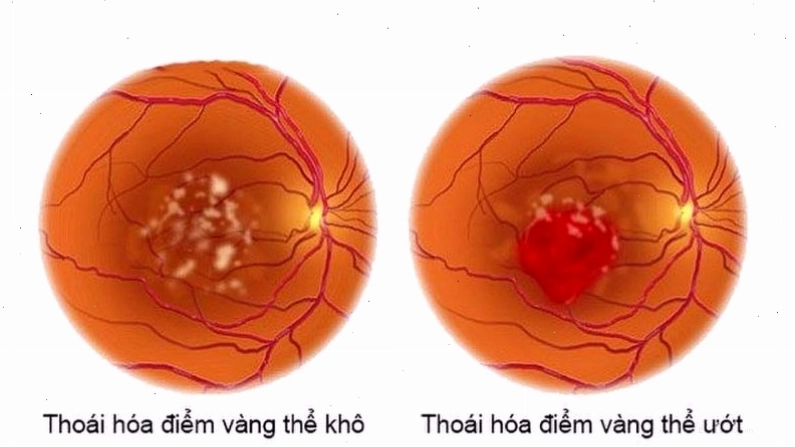 Tiếp xúc với ánh sáng xanh có thể gây thoái hoá điểm vàng