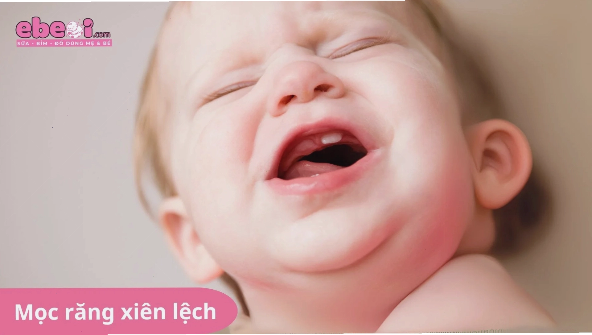 Tình trạng mọc răng xiên lệch ở trẻ