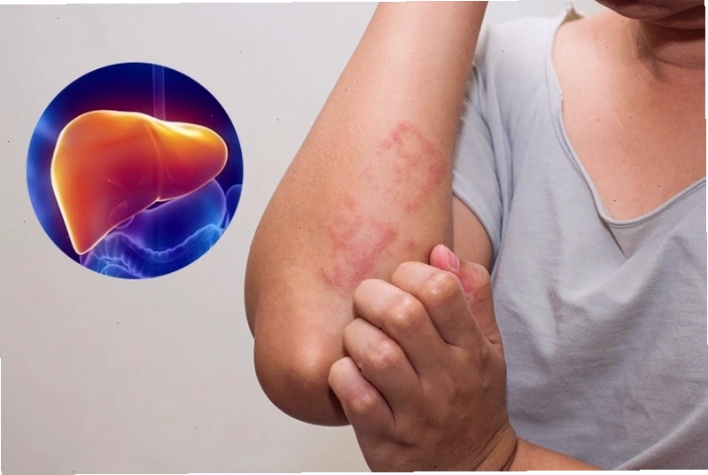 Tỏi đen không rõ nguồn gốc hoặc bảo quản sai cách có thể gây tổn thương gan