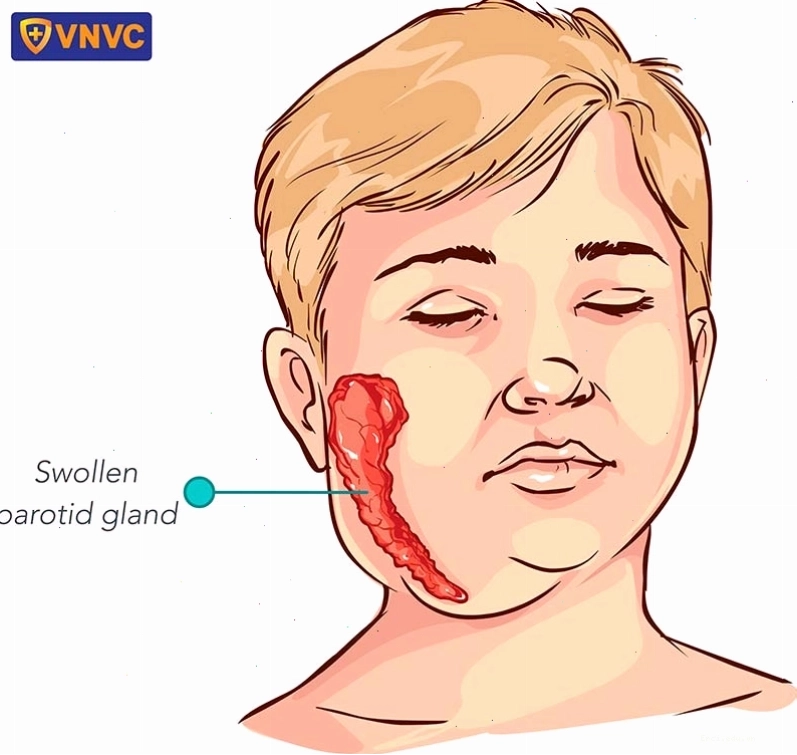 Trẻ bị sưng tuyến mang tai là triệu chứng điển hình của bệnh quai bị