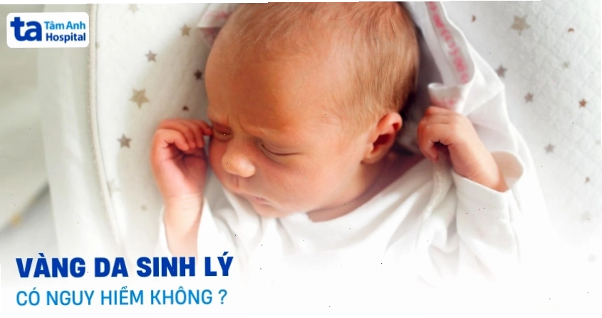 Trẻ sơ sinh có dấu hiệu vàng da sinh lý