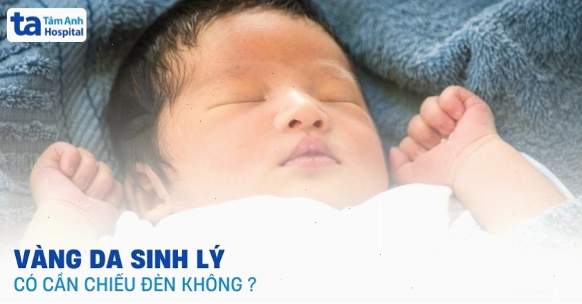 Trẻ sơ sinh vàng da cần theo dõi và có thể chiếu đèn nếu cần