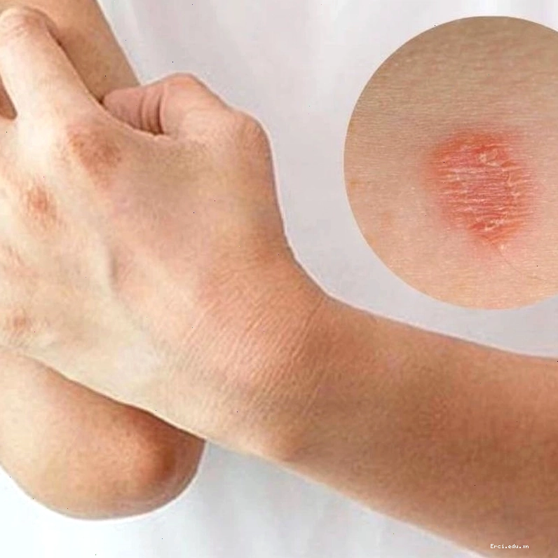 Triệu chứng bị nấm mèo ở người với các mảng đỏ trên da