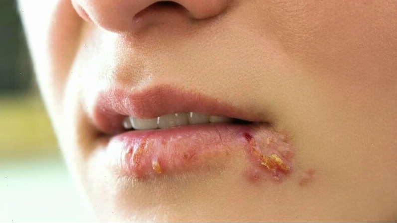 Triệu chứng chốc mép xuất hiện mụn nước nhỏ li ti quanh khóe miệng