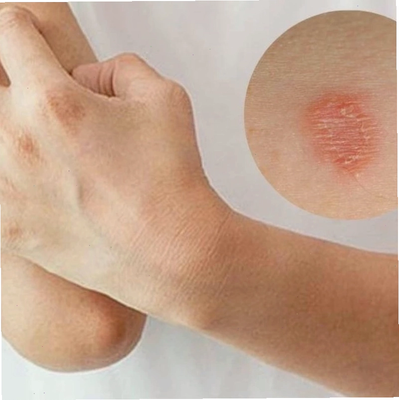 Triệu chứng điển hình của nấm mèo ở người với mảng đỏ và bong tróc da