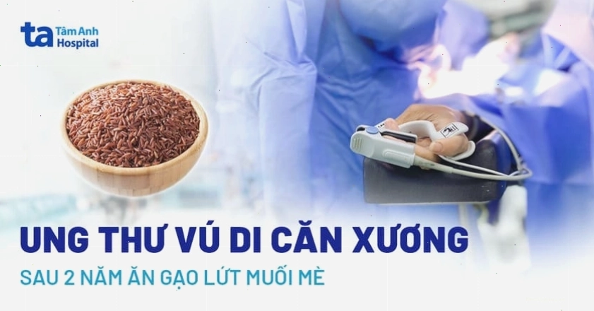 Ung thư vú di căn xương là biến chứng nguy hiểm của ung thư vú
