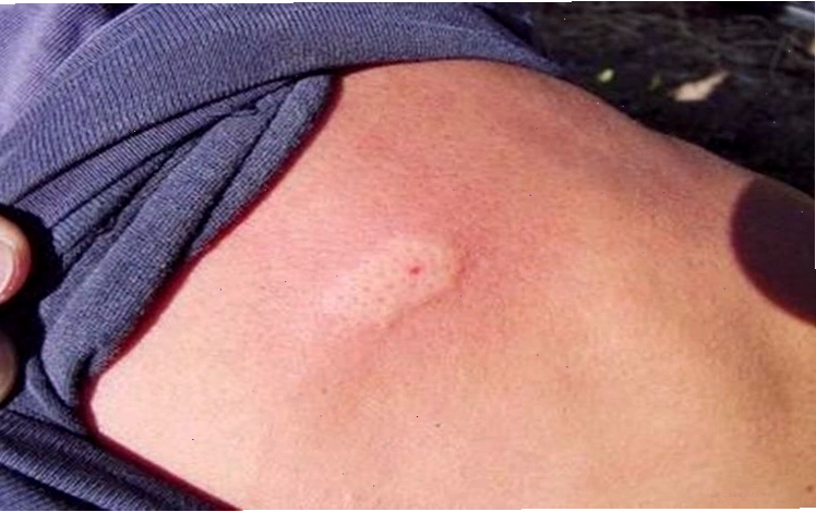 Vết bọ cạp cắn gây sưng và cảm giác đau râm ran