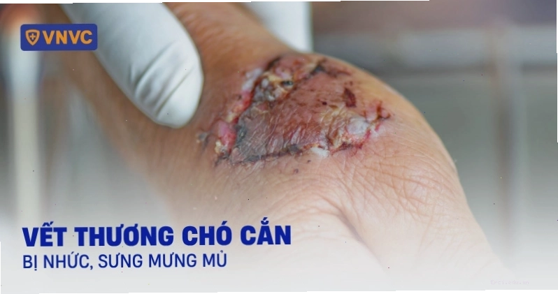 Vết thương chó cắn bị nhức và mưng mủ