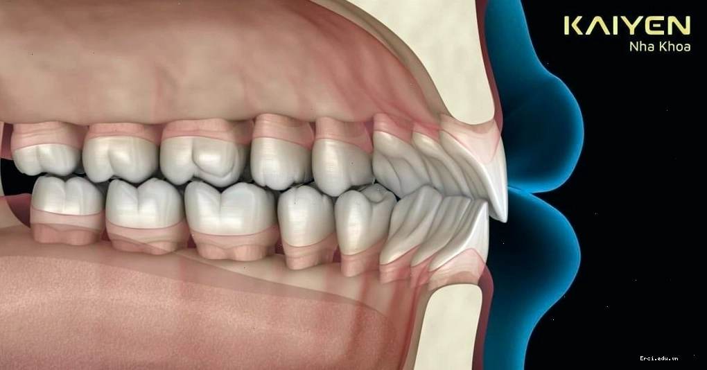 Ví dụ minh họa tình trạng hô răng nhẹ