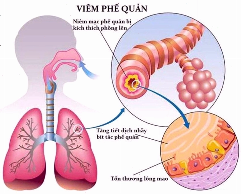 Vị trí tổn thương của viêm phế quản