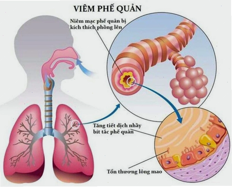 Vị trí tổn thương trong viêm phế quản là lớp niêm mạc bên trong phế quản