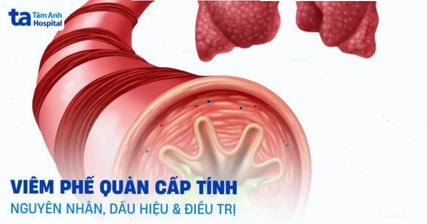 Viêm phế quản cấp tính