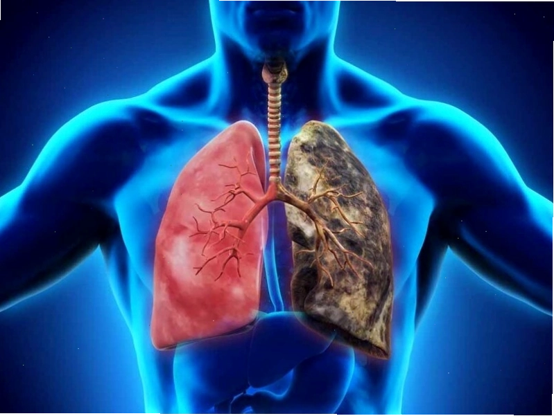 Viêm phổi thường có tiên lượng xấu hơn viêm phế quản
