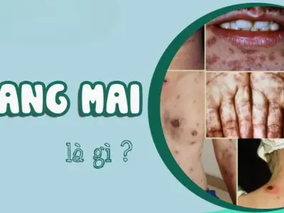 Giang mai là gì? Những thông tin cần biết để bảo vệ sức khỏe