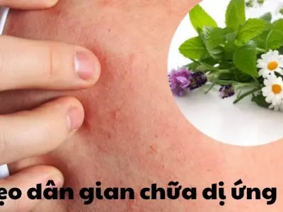 Bài thuốc dân gian chữa dị ứng khiến ai cũng bất ngờ