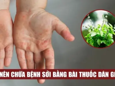 Cách áp dụng mẹo dân gian chữa sởi an toàn tại nhà