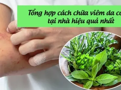 Mẹo dân gian chữa viêm da cơ địa khiến ai cũng ngạc nhiên