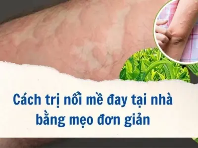 Hết ngứa hết sưng nhờ mẹo dân gian chữa mề đay tại nhà
