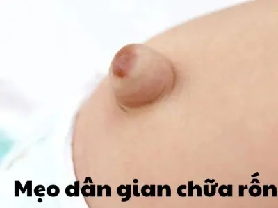 Cách áp dụng mẹo dân gian chữa rốn lồi hiệu quả tại nhà