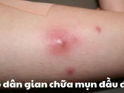 Khám phá ngay mẹo dân gian chữa mụn đầu đinh nhanh khỏi