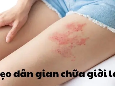 Mẹo dân gian chữa giời leo hiệu quả không phải ai cũng biết