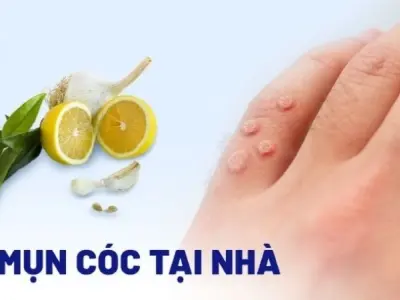 Mẹo trị mụn cóc dân gian hiệu quả khiến ai cũng sửng sốt