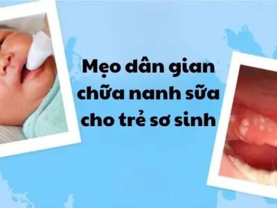 Bật mí mẹo dân gian chữa nanh sữa cho trẻ sơ sinh an toàn