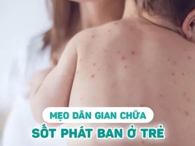 Mẹo dân gian chữa sốt phát ban tại nhà hiệu quả nhanh