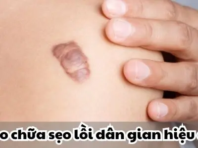 Mẹo chữa sẹo lồi dân gian hiệu quả bất ngờ từ thiên nhiên