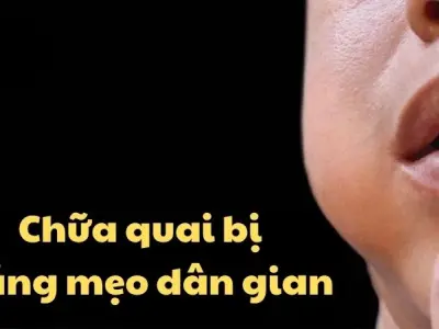 Bất ngờ với mẹo chữa quai bị dân gian lâu đời cực hiệu quả