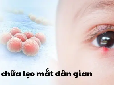 Bất ngờ với mẹo chữa lẹo mắt dân gian xưa hiệu quả bất ngờ