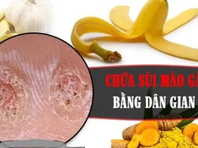 Tổng hợp mẹo dân gian chữa sùi mào gà từ xưa đến nay