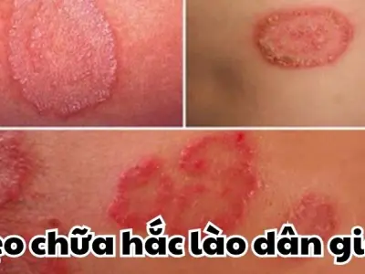 Mẹo chữa hắc lào dân gian đơn giản nhưng cực hiệu quả