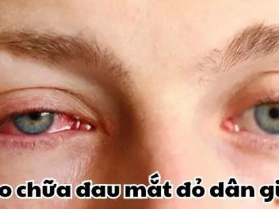 Giật mình với mẹo chữa đau mắt đỏ dân gian cực hiệu quả