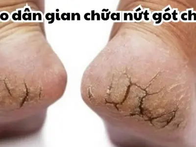Hé lộ mẹo dân gian chữa nứt gót chân từ kinh nghiệm xưa