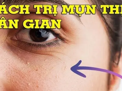Bí kíp mẹo dân gian chữa mụn thịt hiệu quả không để lại sẹo